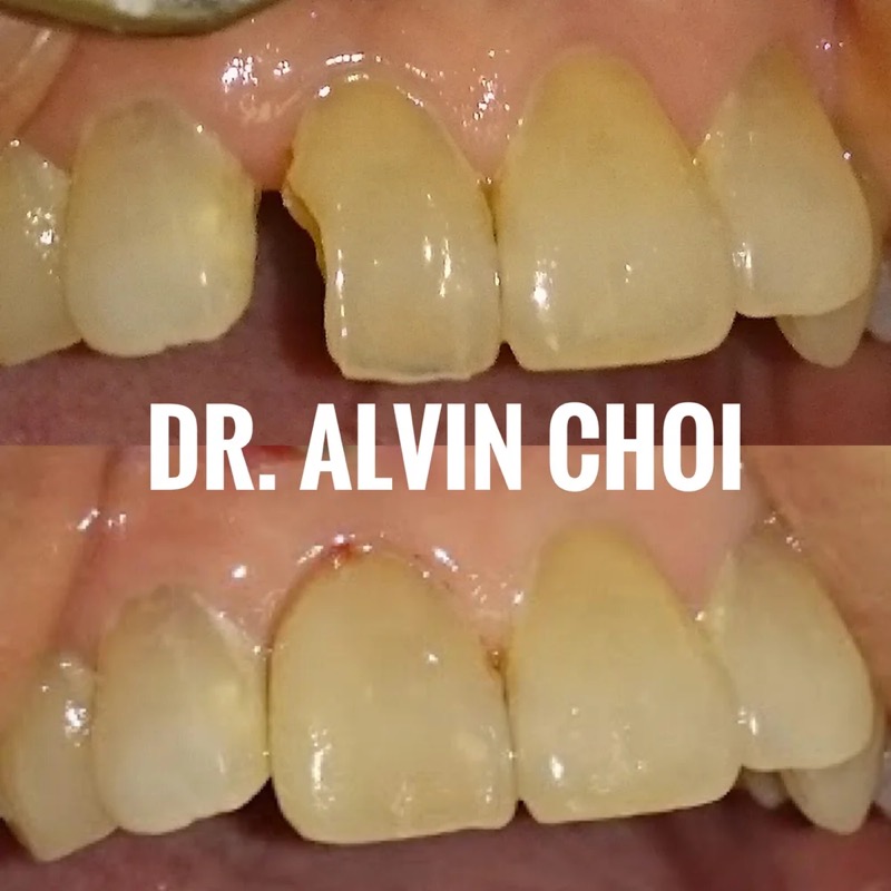 Same-day repair — a tooth broken in an injury, restored the same day with tooth-coloured material.