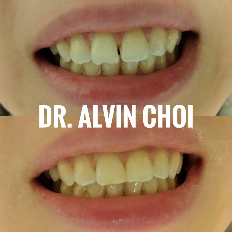 Closing a front-tooth gap — natural gaps closed with conservative bonding.