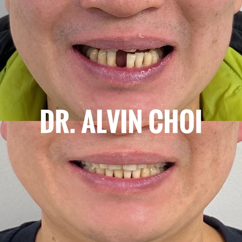 Invisalign + implant — teeth realigned and a missing tooth restored after gum disease.