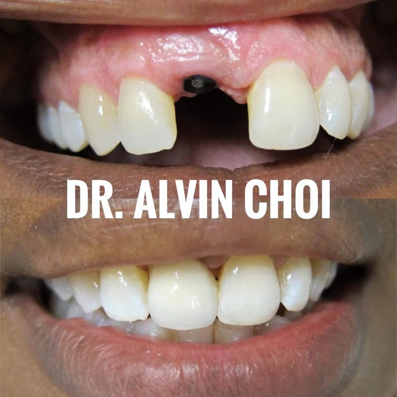 Implant — a lost front tooth replaced, restoring function and a natural look.