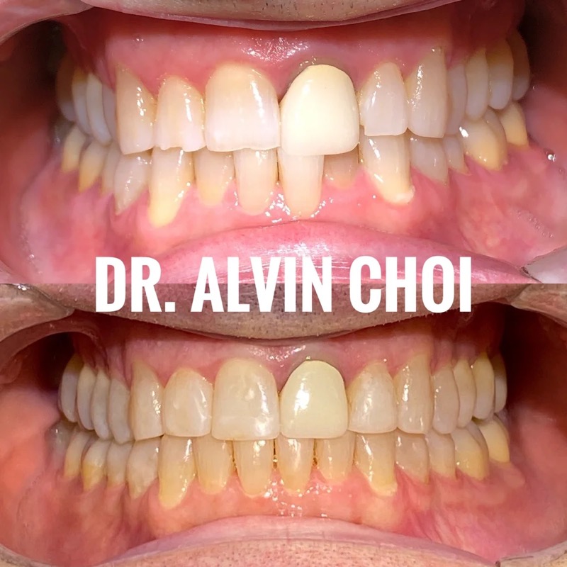 Invisalign — crowded teeth straightened; healthier gums and a brighter smile.