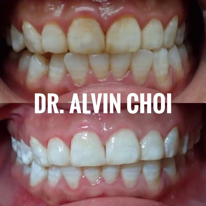 Whitening & bonding — childhood yellow staining brightened and evened out.